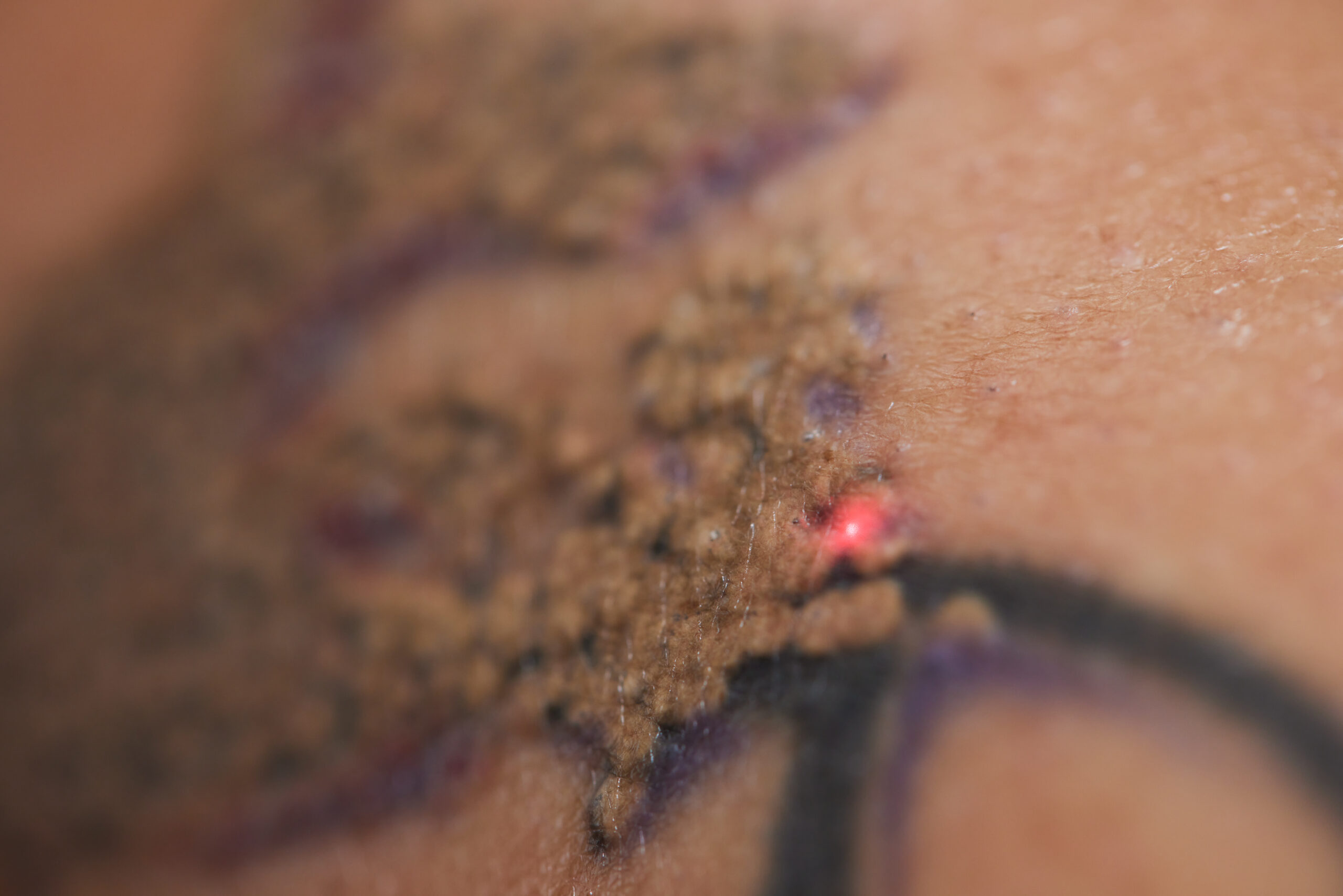 Young woman undergoing laser tattoo removal procedure in salon, closeup